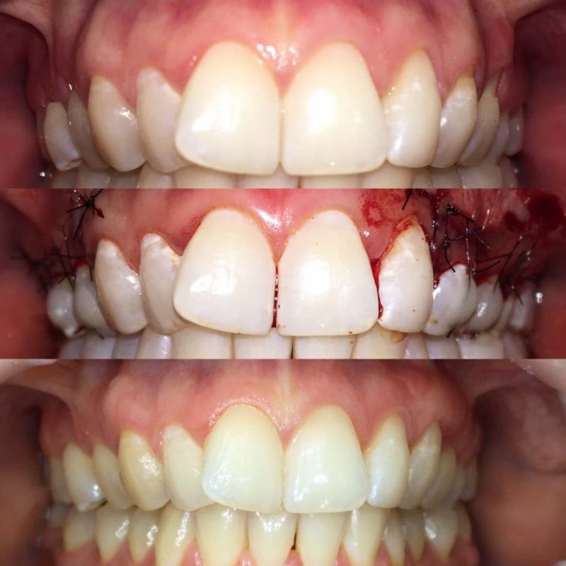 Сложное удаление зуба Томск Мельничная стоматологии томска апекс