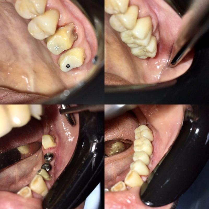 Сложное удаление зуба Томск Мельничная герметик для зубов детям