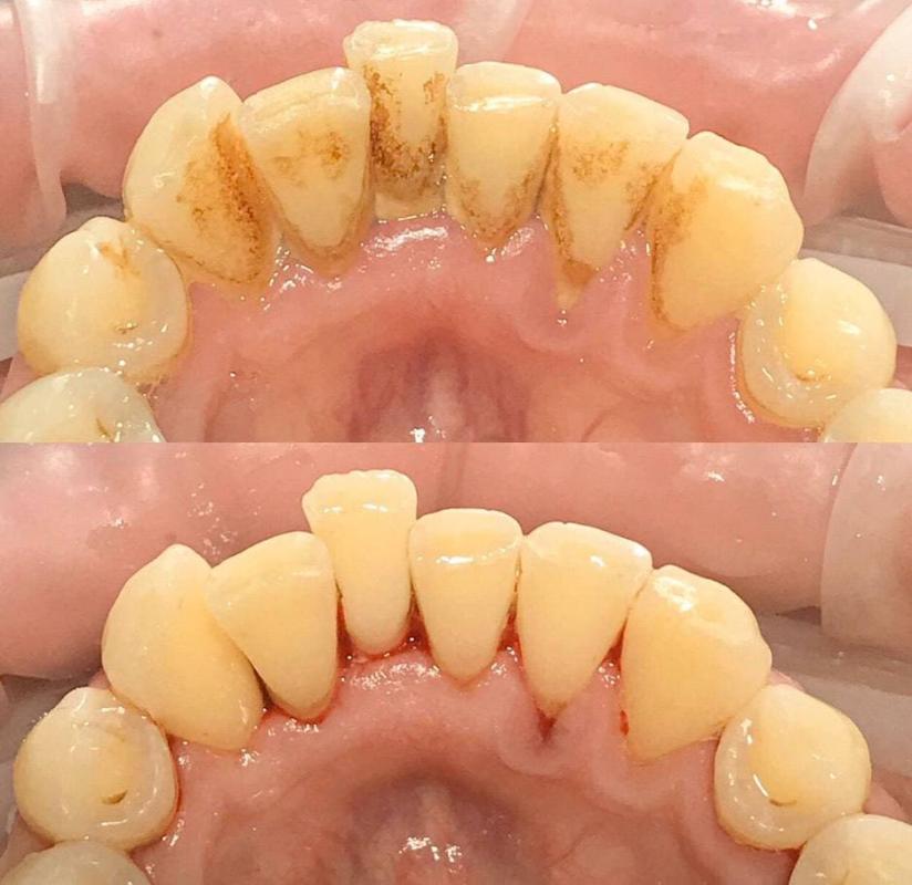 Удаление зубного камня Томск Картасный 3 стоматология томск