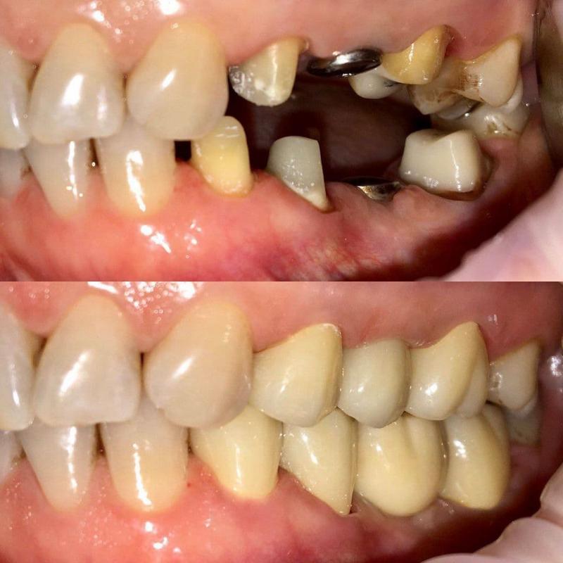 Лечение кариеса Томск Кордон 2-я где в томске лечат зубы