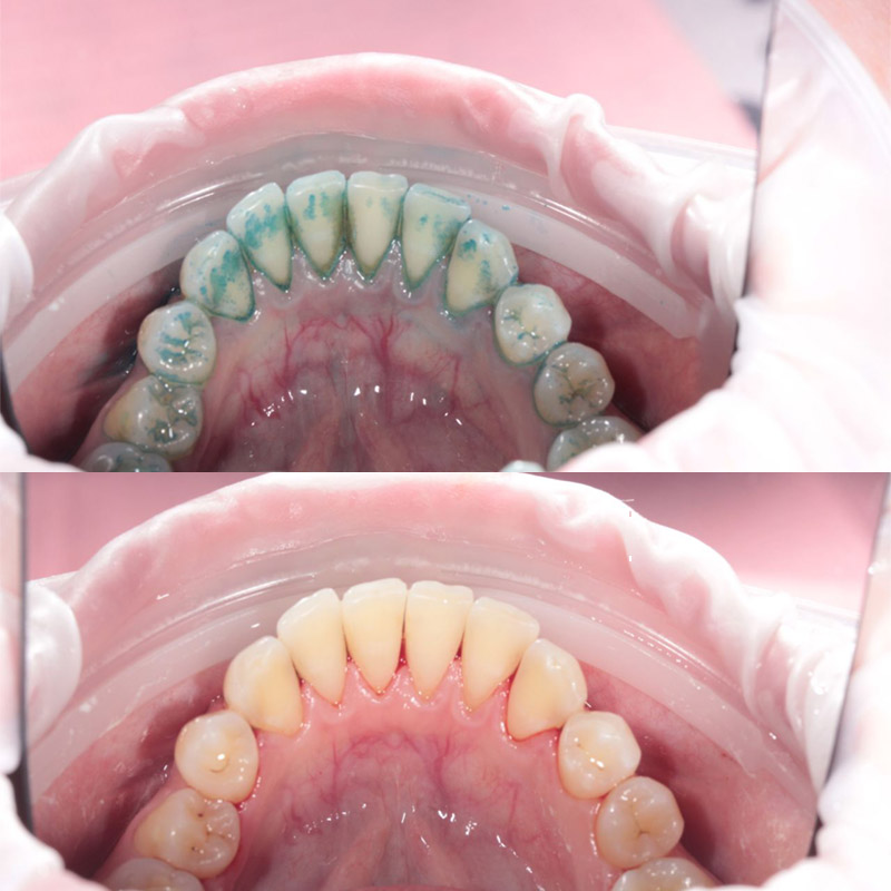 Лечение кариеса Томск Клюева лечение лазером стоматология