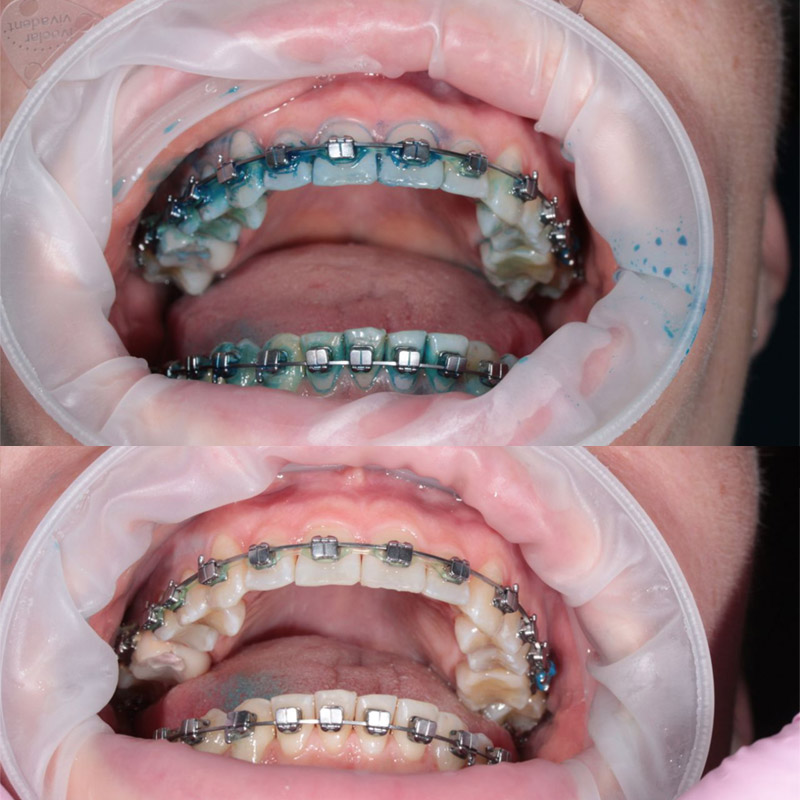 Чистка зубов Air Flow Томск Мира денталия на лебедева стоматология томск