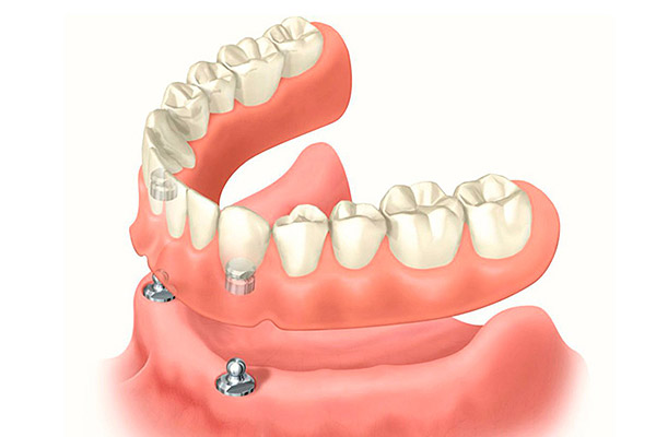 Имплантация зубов «под ключ» Томск Предвокзальная лечение зуба в томске