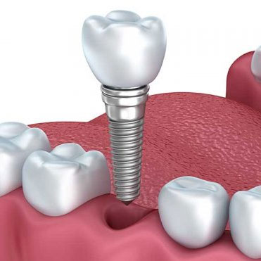 Имплантация зубов «под ключ» Томск Чаинский герметик стоматология