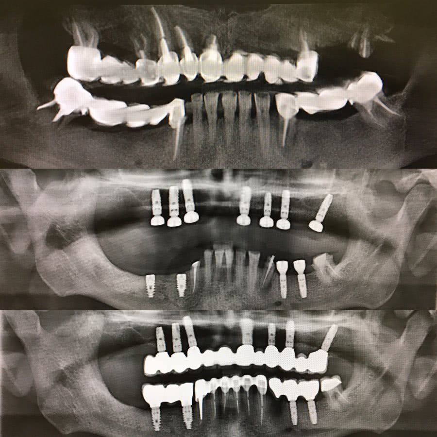 Панорамный снимок зубов Томск Предвокзальная вставить зуб металлокерамика