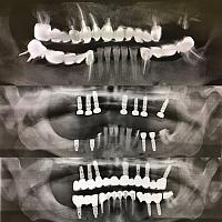 Удаление 8 зубов